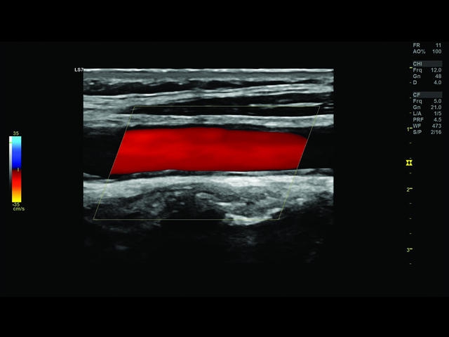 GE Logiq S7 с XDClear